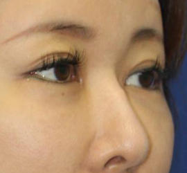 40代女性の目頭切開 After 症例写真