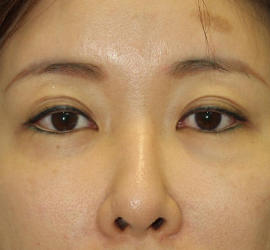 40代女性の目頭切開 Before 症例写真