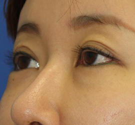 40代女性の目頭切開 Before 症例写真