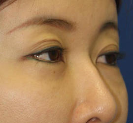 40代女性の目頭切開 Before 症例写真