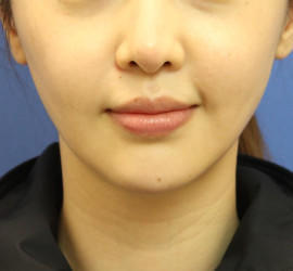 20代女性のエラ・アゴ・小顔 After 症例写真