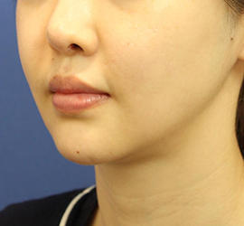 20代女性のメーラーファット除去 After 症例写真