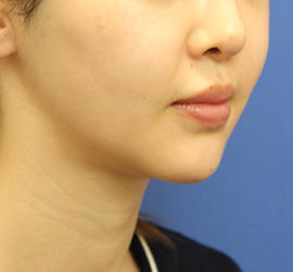 20代女性のメーラーファット除去 After 症例写真