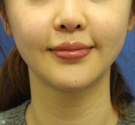 20代女性のエラ・アゴ・小顔 Before 症例写真
