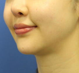 20代女性のメーラーファット除去 Before 症例写真