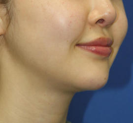 20代女性のメーラーファット除去 Before 症例写真