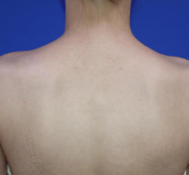 20代女性のボトックス（美肩・肩こり解消） After 症例写真