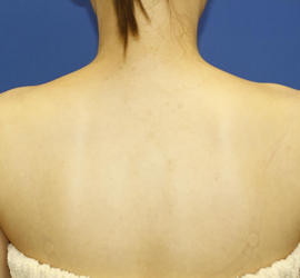 20代女性のボトックス（美肩・肩こり解消） Before 症例写真