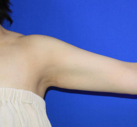 20代女性の脂肪吸引 After 症例写真