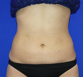 20代女性の脂肪吸引 After 症例写真