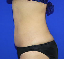 20代女性の脂肪吸引 After 症例写真