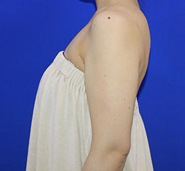 20代女性の脂肪吸引 After 症例写真