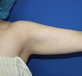 20代女性の脂肪吸引 Before 症例写真