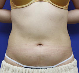 20代女性の脂肪吸引 Before 症例写真