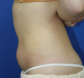 20代女性の脂肪吸引 Before 症例写真