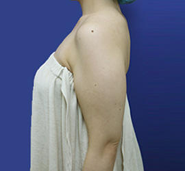 20代女性の脂肪吸引 Before 症例写真