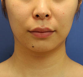 20代女性のシワ・たるみ After 症例写真