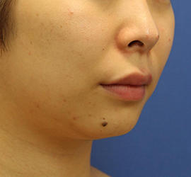 20代女性の顔の脂肪吸引  After 症例写真