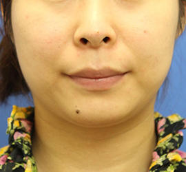 20代女性のシワ・たるみ Before 症例写真