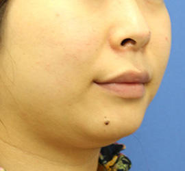 20代女性の顔の脂肪吸引  Before 症例写真