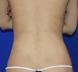 20代女性の脂肪吸引 After 症例写真