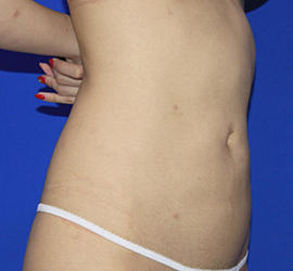 20代女性の脂肪吸引 After 症例写真