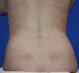 20代女性の脂肪吸引 Before 症例写真