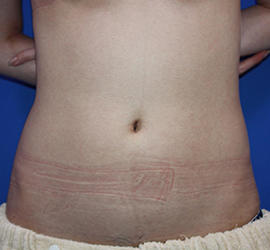 20代女性の脂肪吸引 Before 症例写真