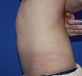 20代女性の脂肪吸引 Before 症例写真