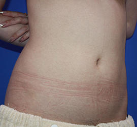 20代女性の脂肪吸引 Before 症例写真