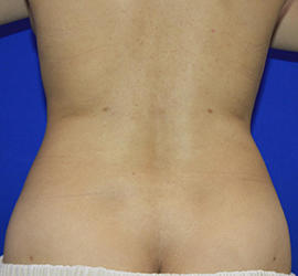 20代女性の脂肪吸引 After 症例写真