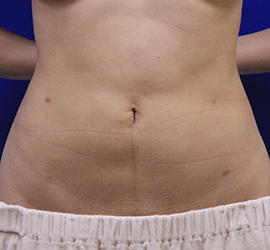 20代女性の脂肪吸引 After 症例写真