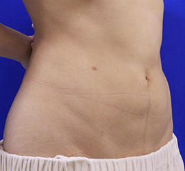 20代女性の脂肪吸引 After 症例写真