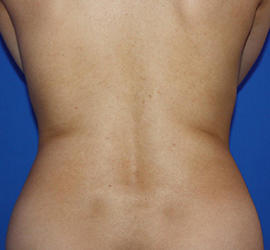 20代女性の脂肪吸引 Before 症例写真