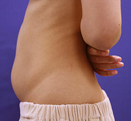 20代女性の脂肪吸引 Before 症例写真