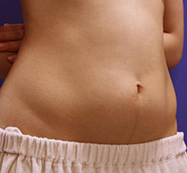 20代女性の脂肪吸引 Before 症例写真