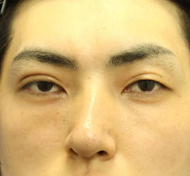 20代男性の目の下のクマ治療 After 症例写真