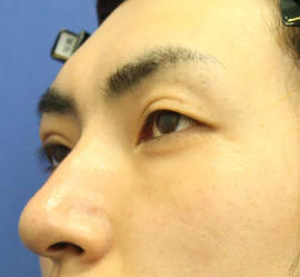 20代男性の3Dリポアイリフト  After 症例写真