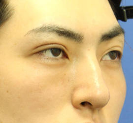 20代男性の3Dリポアイリフト  After 症例写真