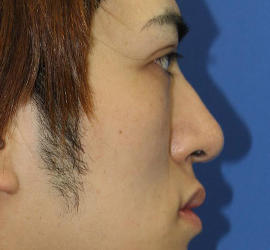 20代男性の3Dリポアイリフト  After 症例写真