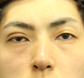 20代男性の目の下のクマ治療 Before 症例写真