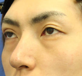 20代男性の3Dリポアイリフト  Before 症例写真