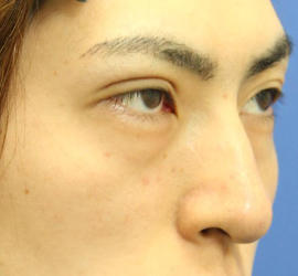 20代男性の3Dリポアイリフト  Before 症例写真