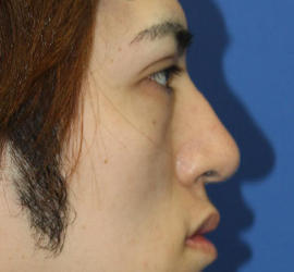 20代男性の3Dリポアイリフト  Before 症例写真