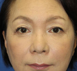 60代女性のシワ・たるみ After 症例写真