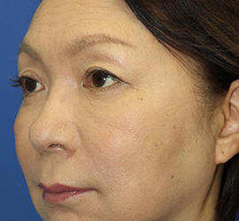 60代女性の下まぶたのたるみ取り After 症例写真