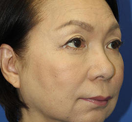 60代女性の下まぶたのたるみ取り After 症例写真