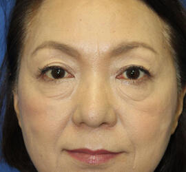 60代女性のシワ・たるみ Before 症例写真