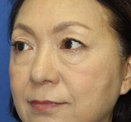 60代女性の下まぶたのたるみ取り Before 症例写真