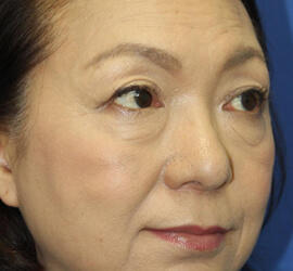 60代女性の下まぶたのたるみ取り Before 症例写真